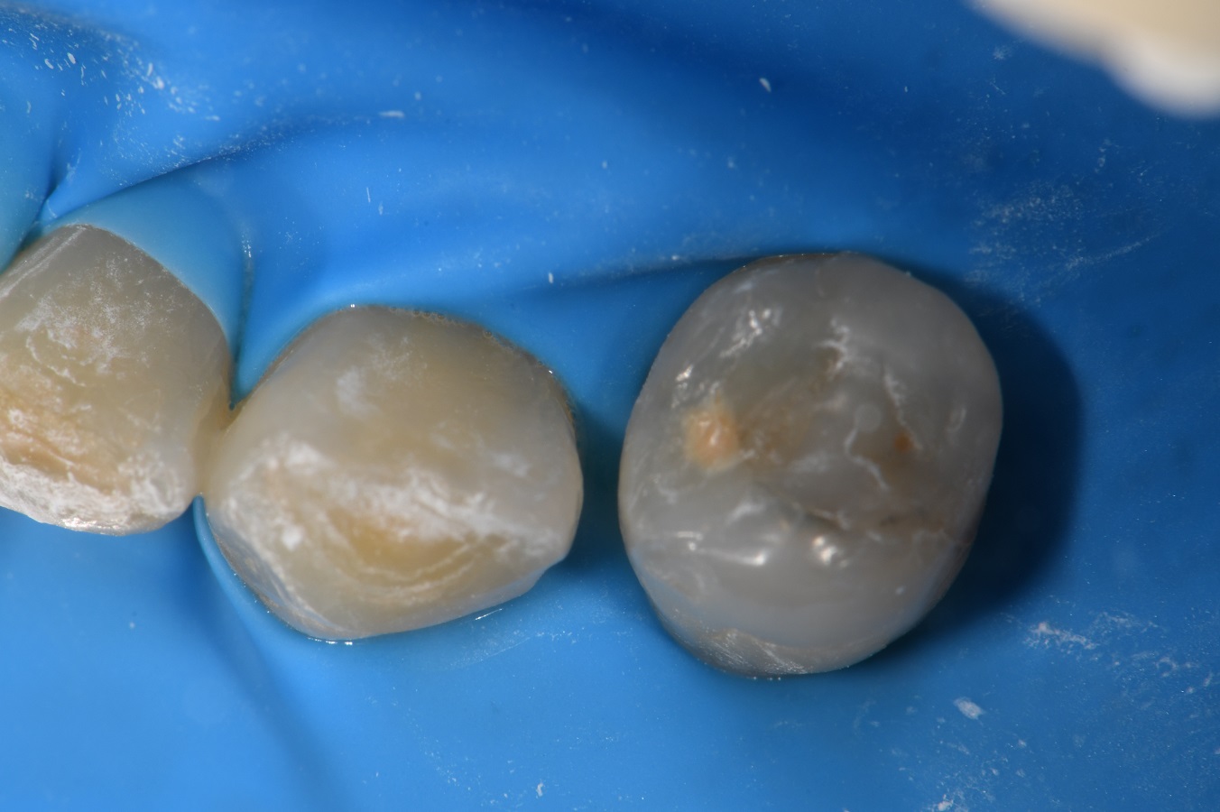 Bicuspid Class II Composite Matrix in Matrix