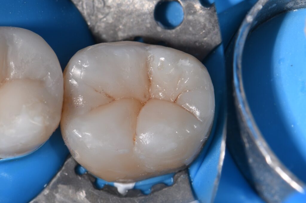 Chasing Cracks in Heavily Restored Teeth Chasing Cracks in Heavily