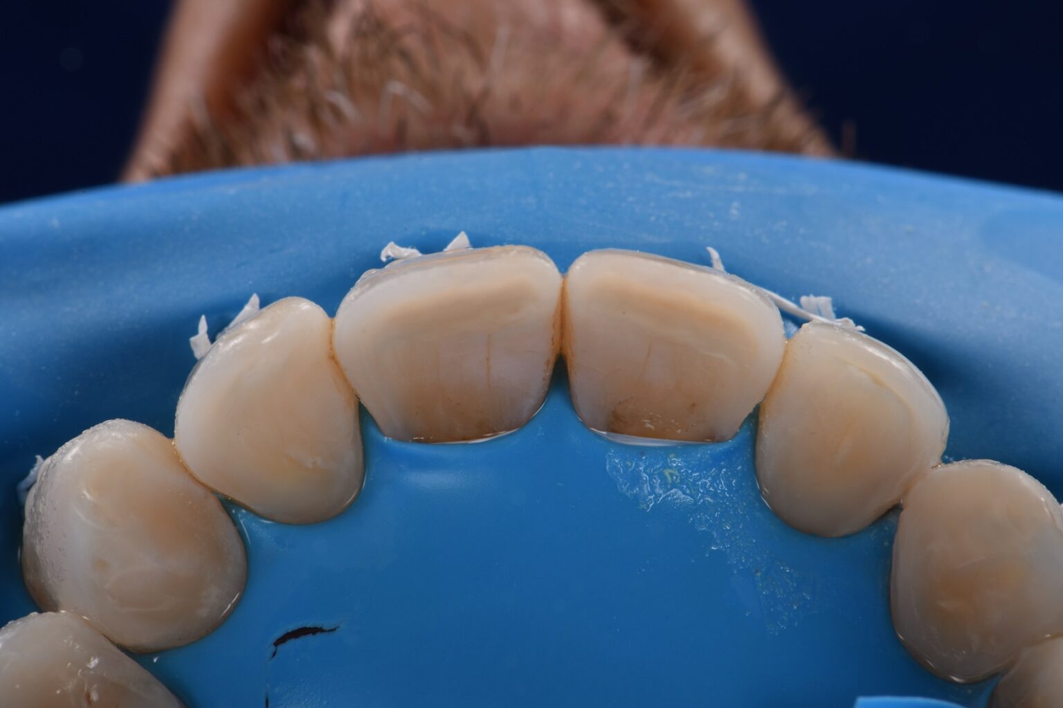 Dental Erosion Restorations Dental Erosion Restorations