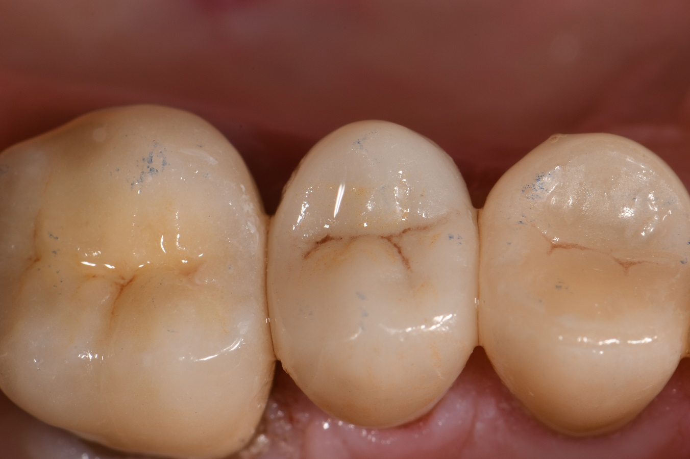 Reinforcing old Crowned Teeth Reinforcing old Crowned Teeth