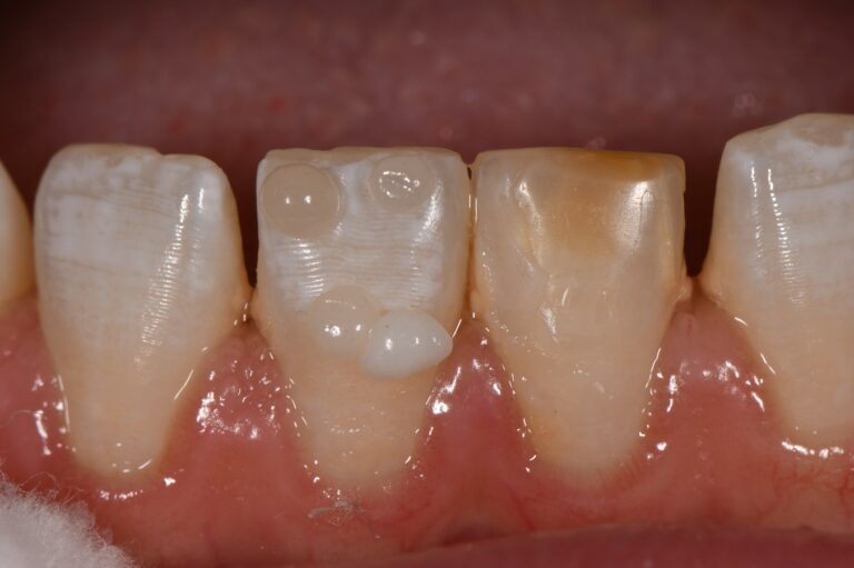 Composite Veneer Incisor Yellow Spot Hypomin