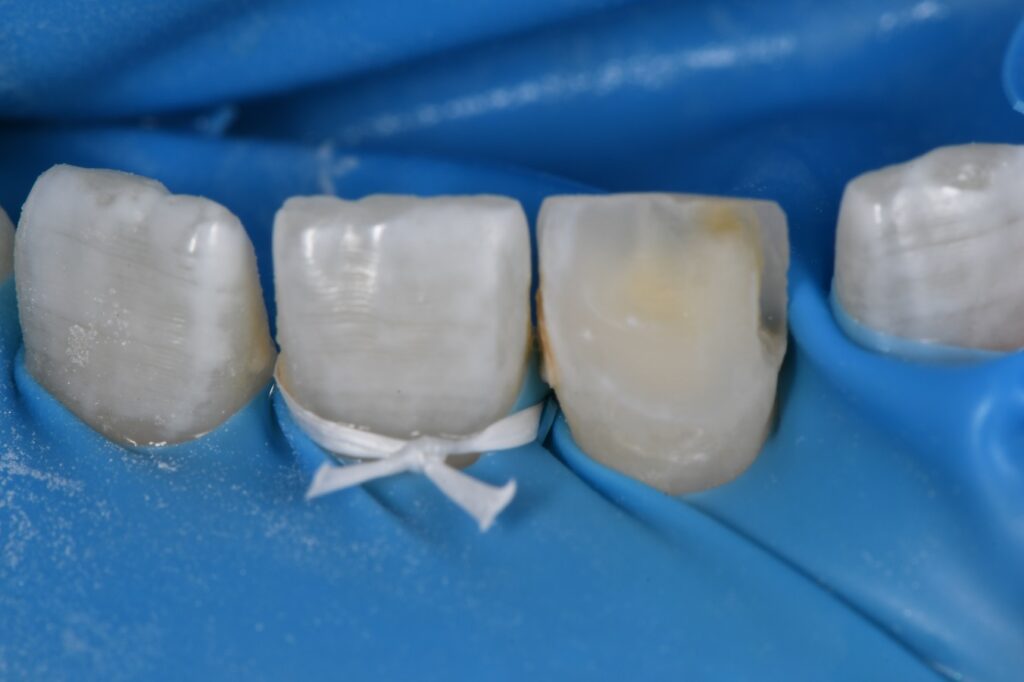 Composite Veneer Incisor Yellow Spot Hypomin