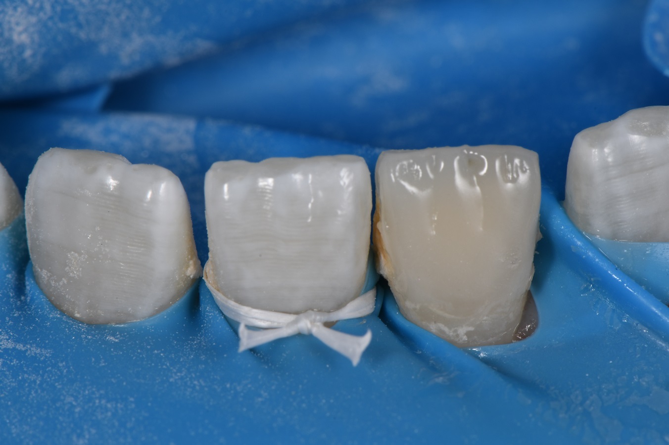 Composite Veneer Incisor Yellow Spot Hypomin