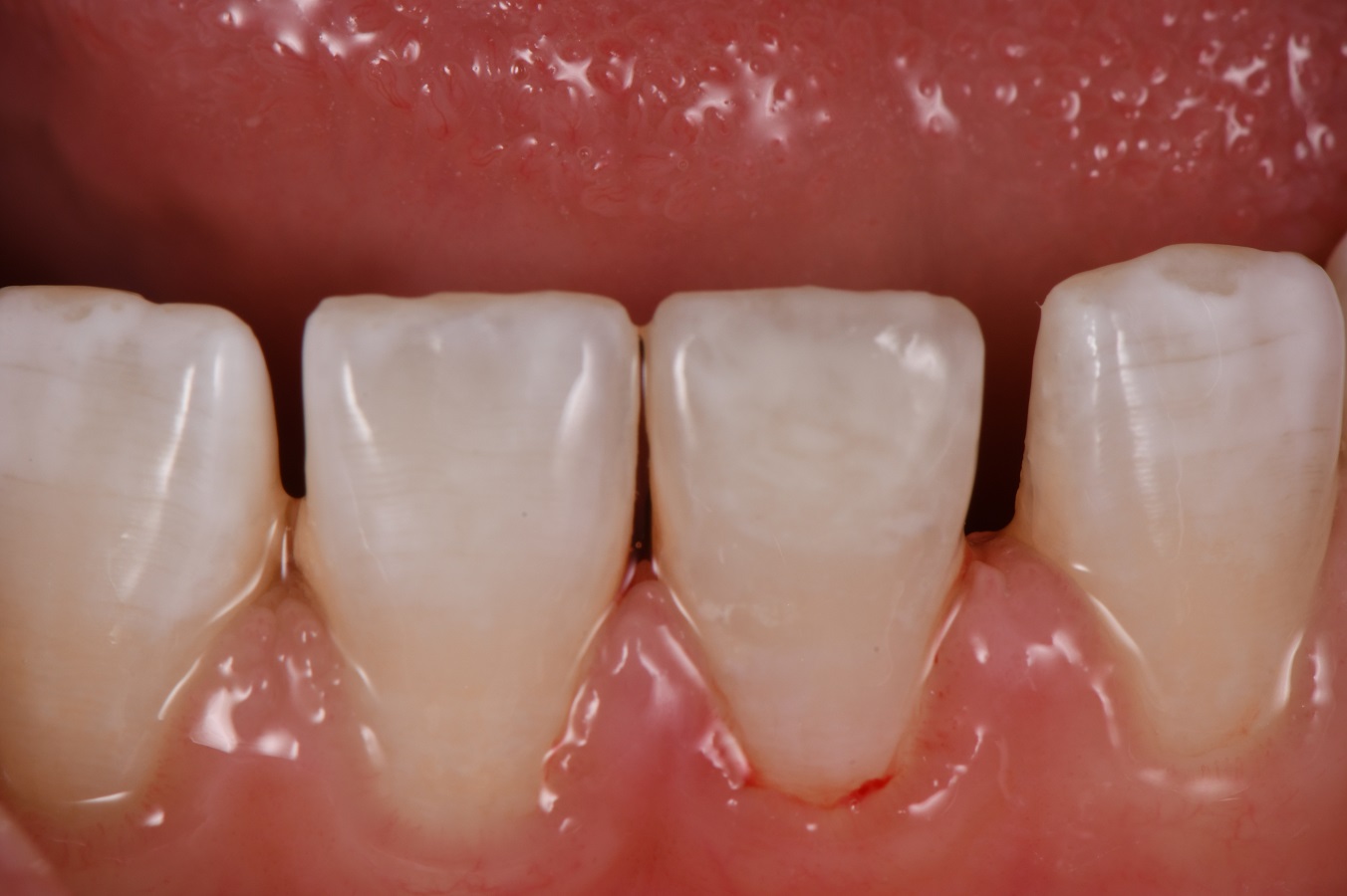 Composite Veneer Incisor Yellow Spot Hypomin