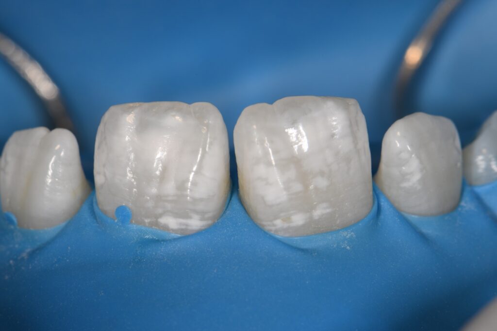 Resin Infiltration Incisor Hypomineralization