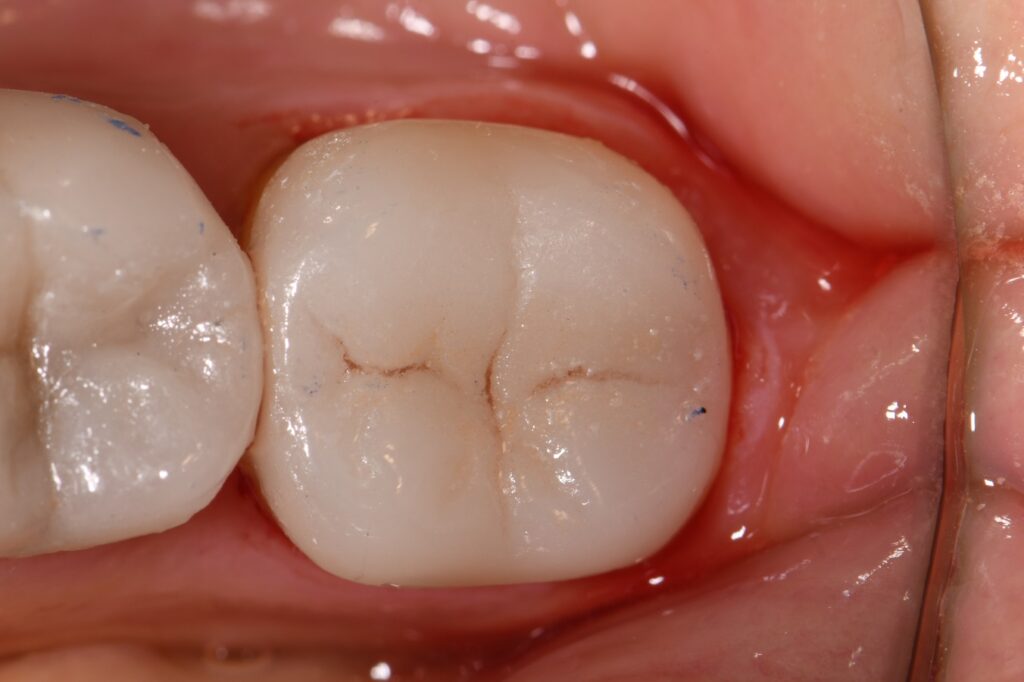 Bonded Dental Crowns