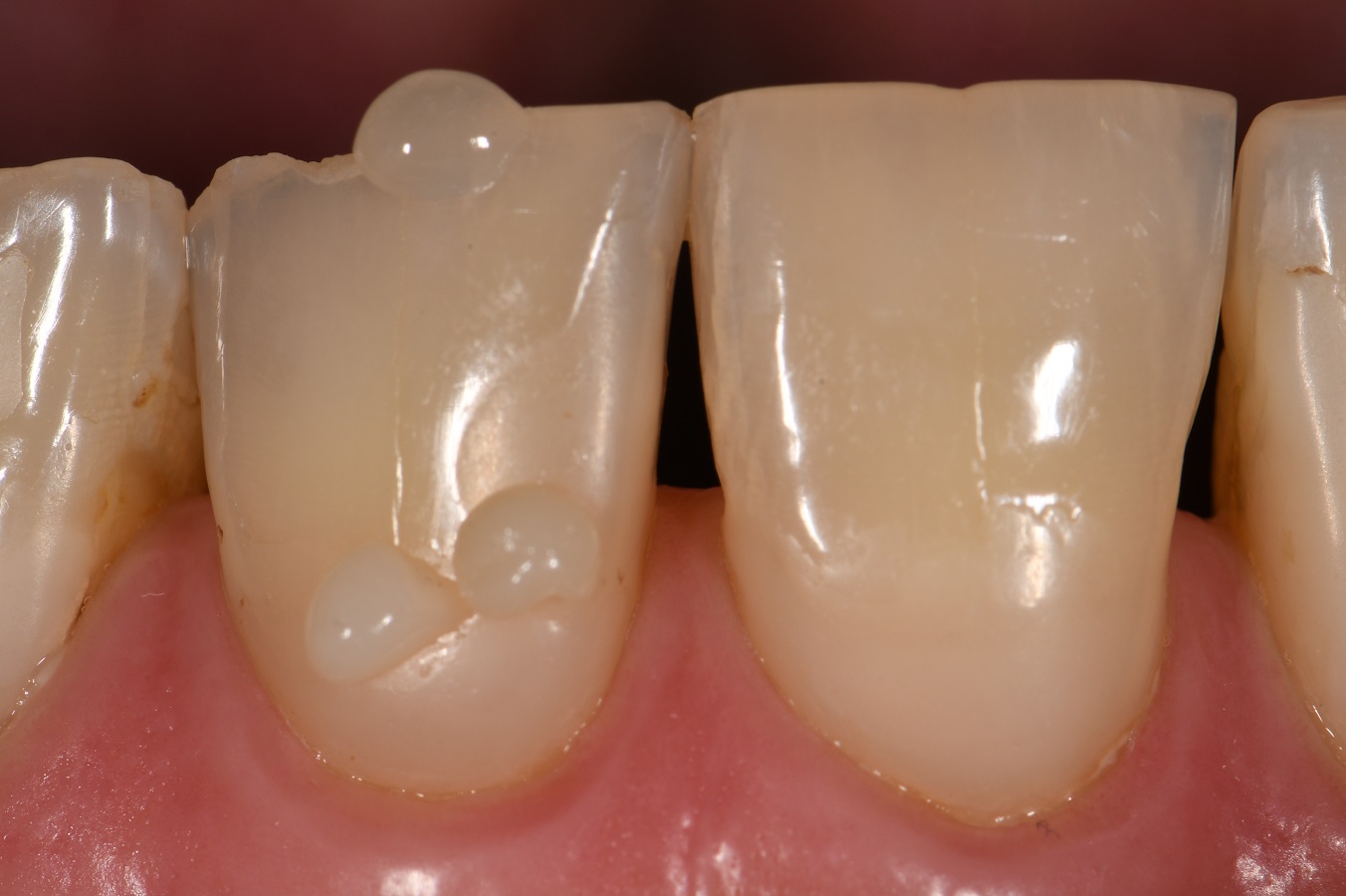 Enamel Fracture Repaired Voco Amaris Enamel Fracture Repaired Voco Amaris