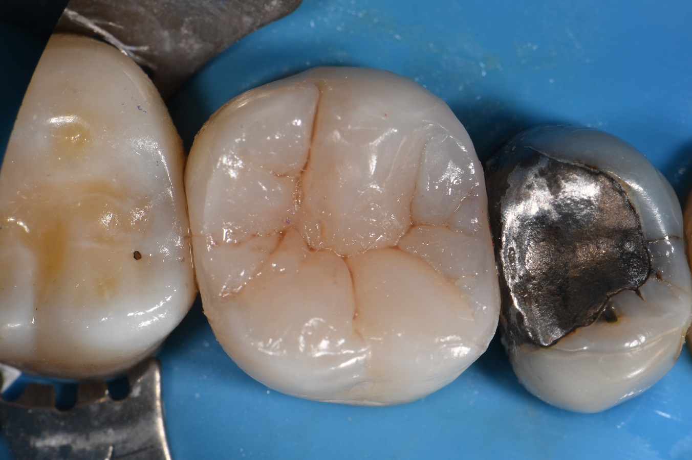 Garrison Dental Wide Prep Ring Class II Solution