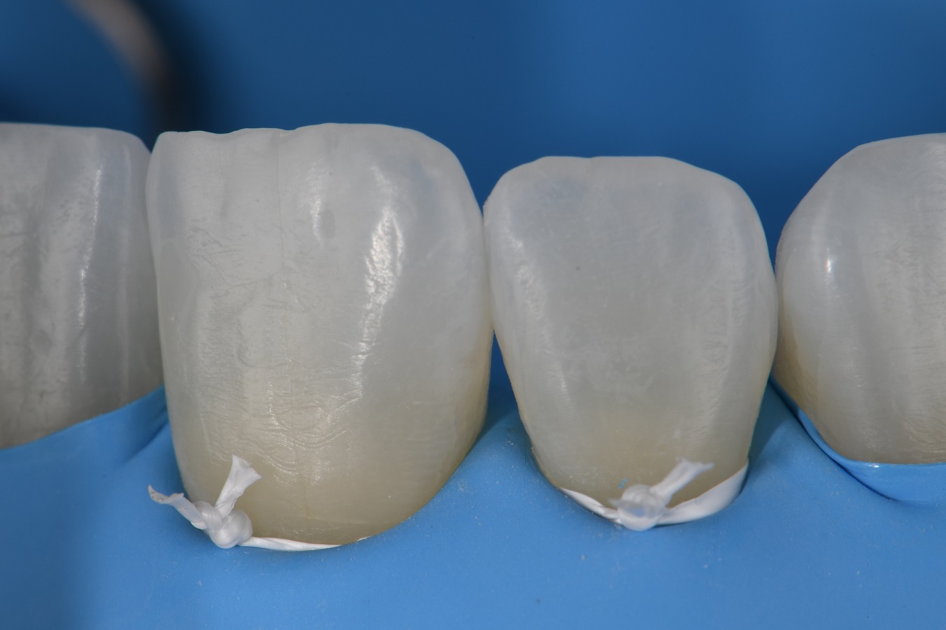 Black Triangle Closure Gum Loss Black Triangle Closure Gum Loss