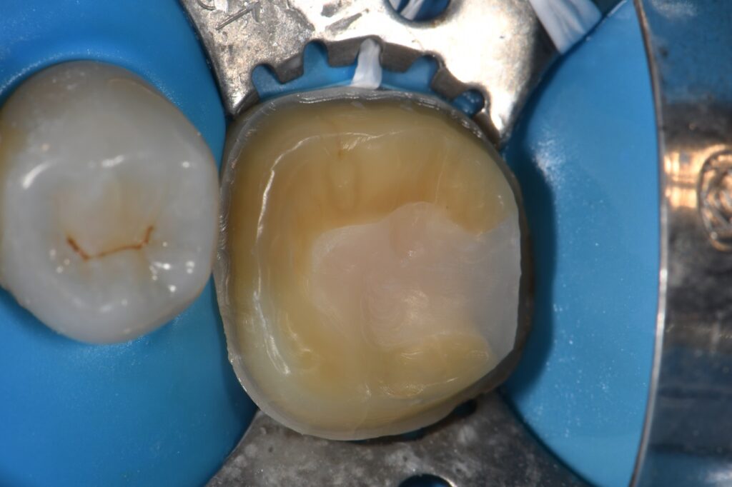 Dental Crown Auckland Dental Crown Auckland