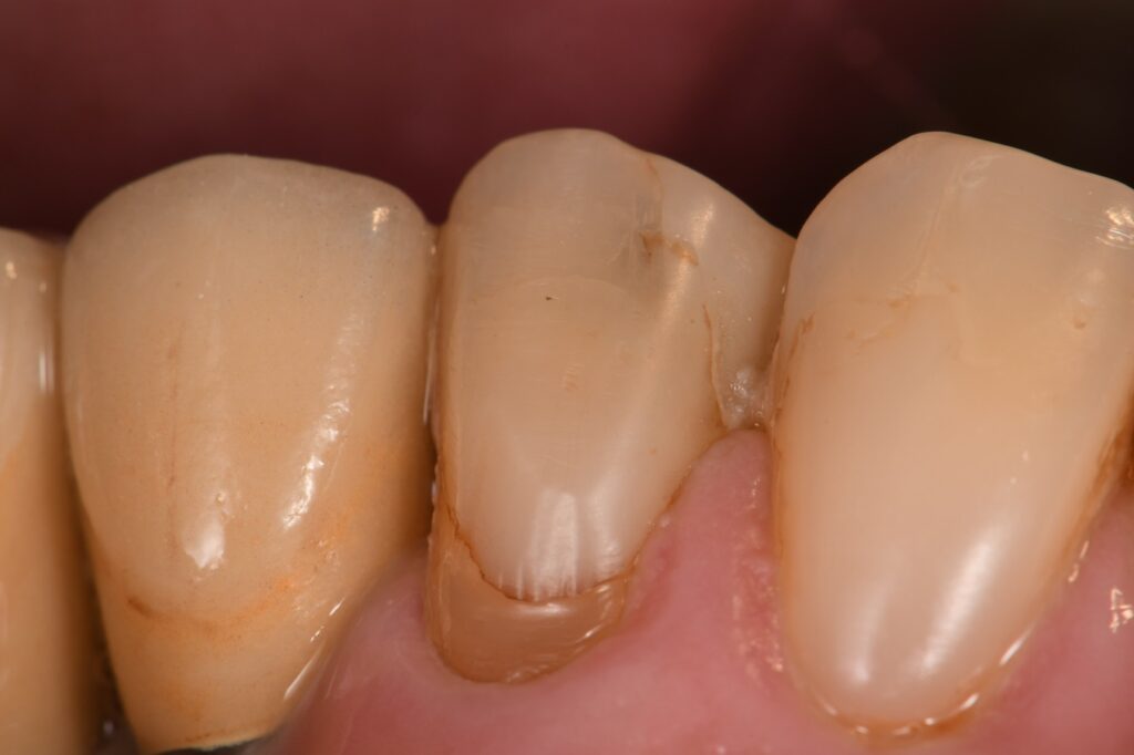 Partial composite restoration addition Partial composite restoration