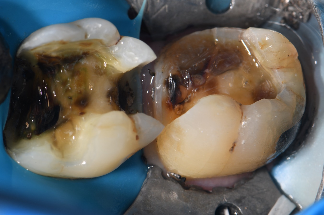 Extreme Composite Resin Restorations Extreme Composite Resin Restorations