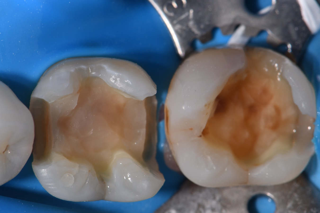 Composite Resin Artistry Cosmetic Dentist Auckland