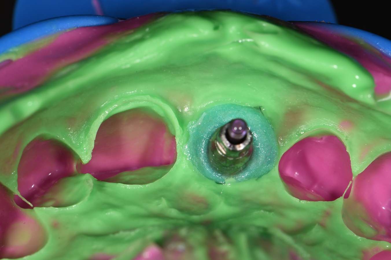Provisional Crown Emergence Capture Dental Implants