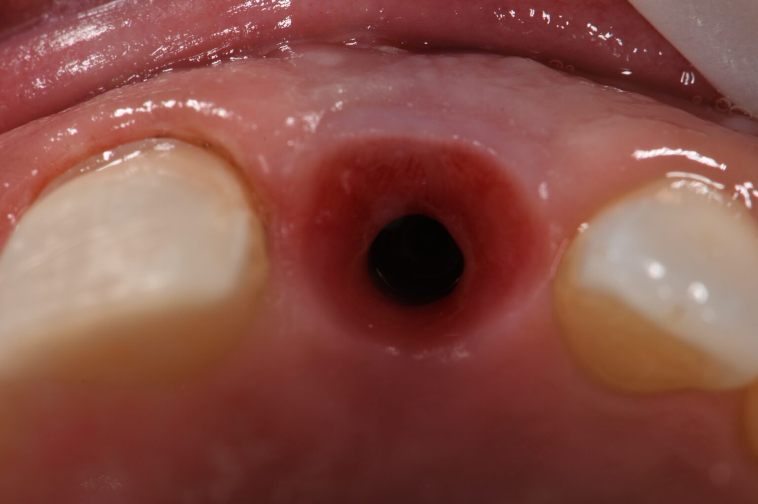 Provisional Crown Emergence Capture Dental Implants