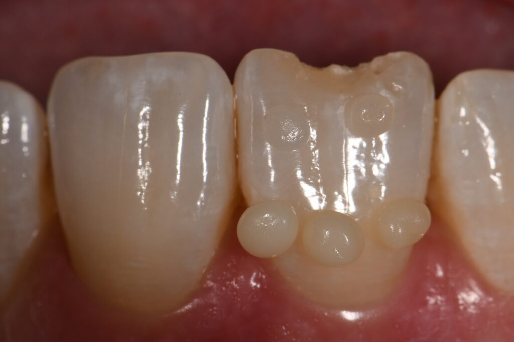 Composite Veneer Voco Amaris