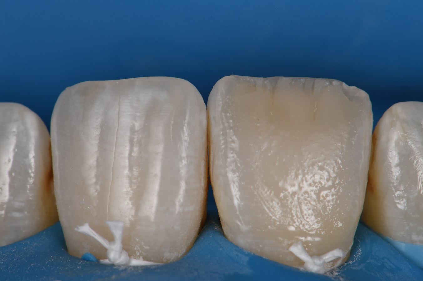 Composite Veneer | Voco Amaris