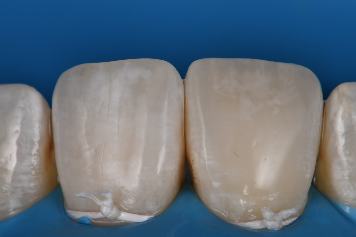 Composite Veneer | Voco Amaris