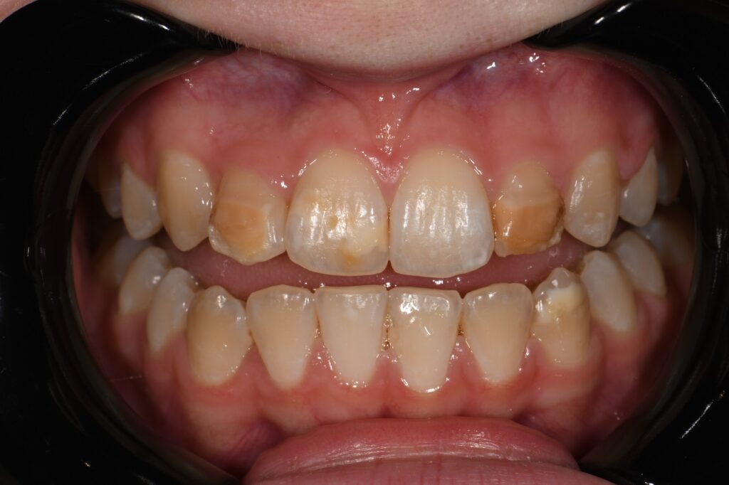 Resin Infiltration and Composite Layering