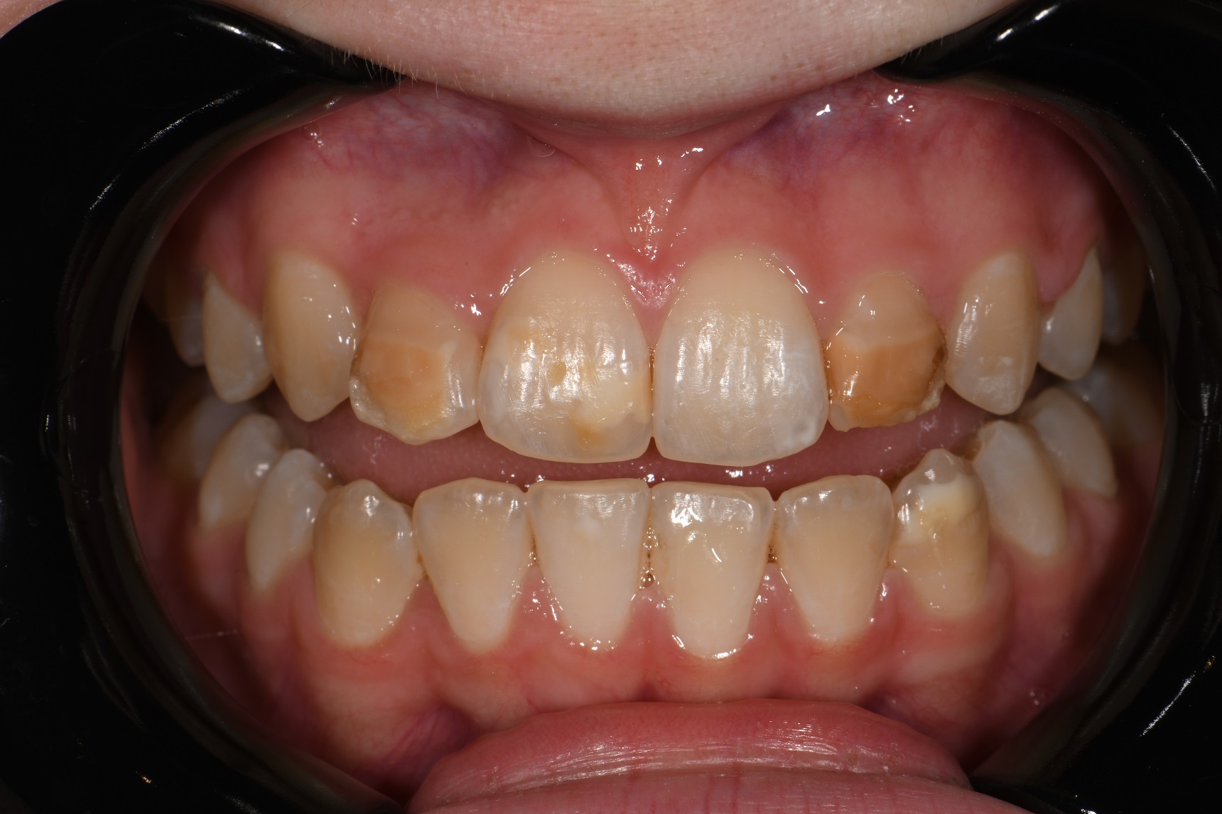 Resin Infiltration and Composite Layering