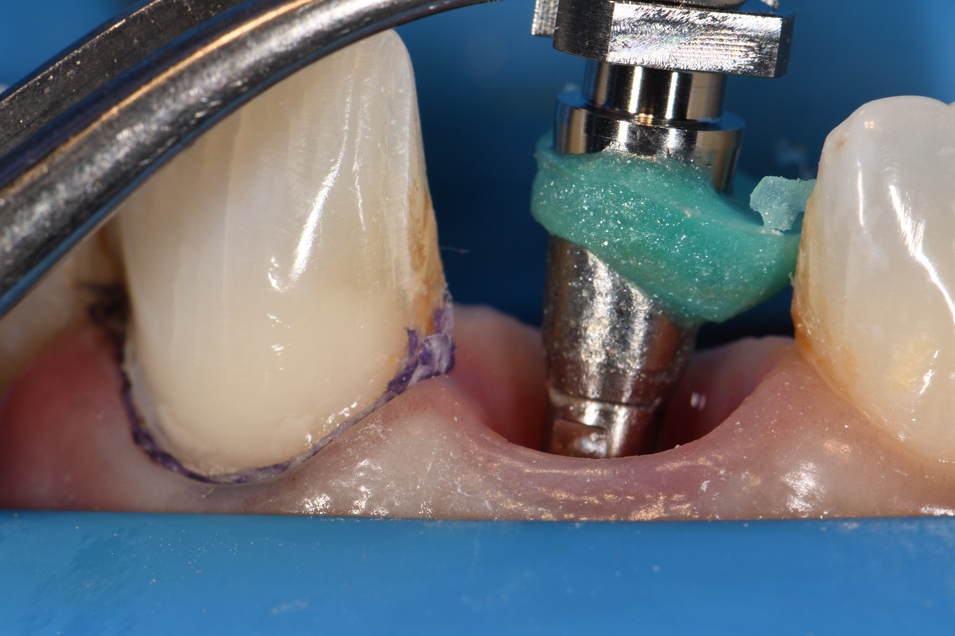 Straumann Angulated Screw Channel