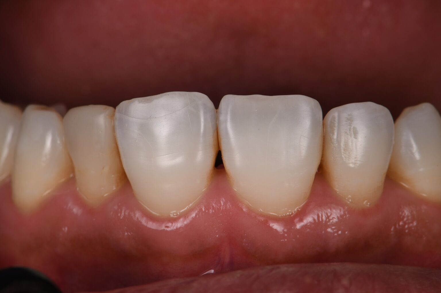 Closing Black Triangles in the Esthetic Zone with Composite