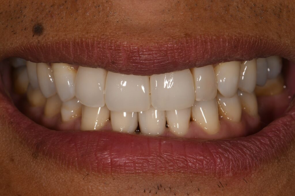 SureSmile Orthodontics and Composite Veneers