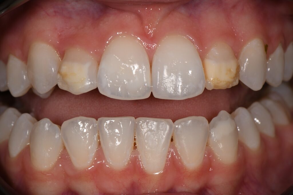 Resin Infiltration and Composite Layering