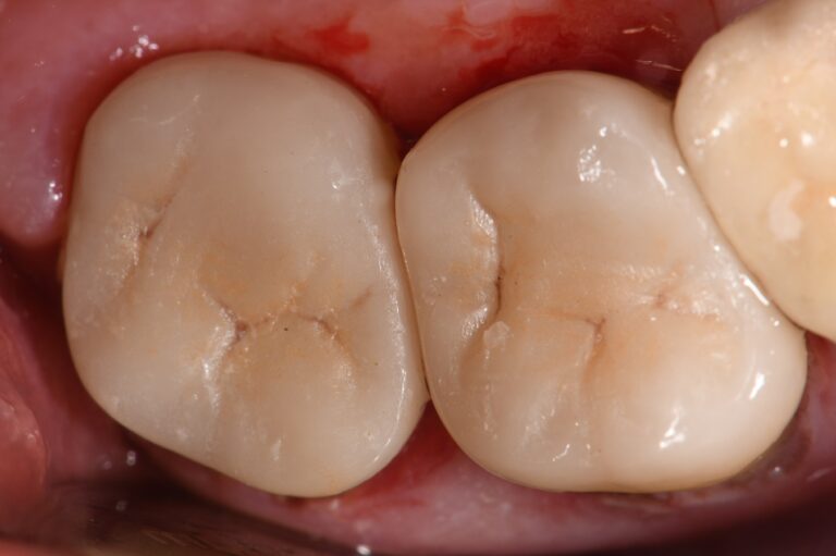 Bonded porcelain overlays