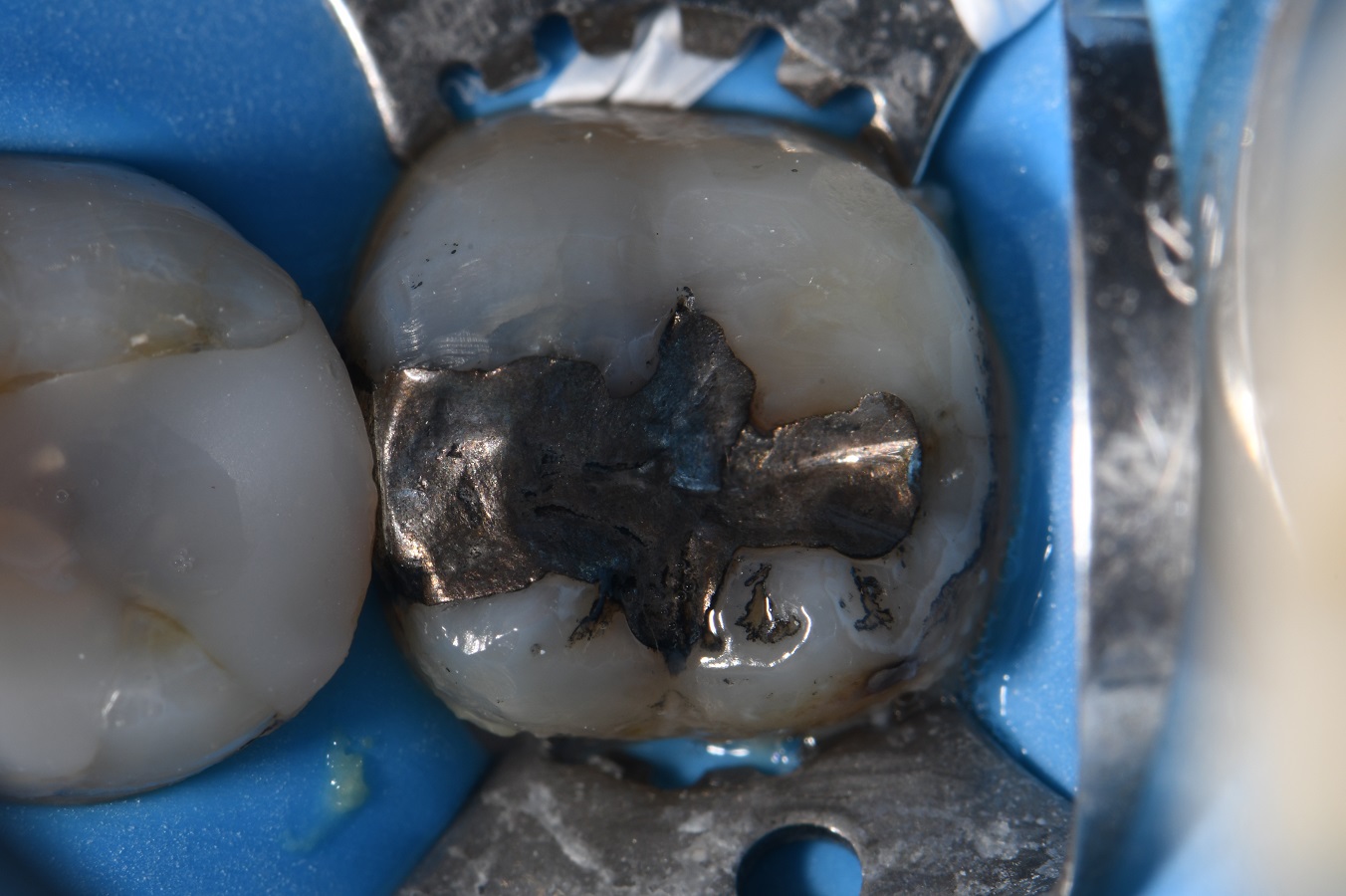 Amalgams Replaced with White Restorations