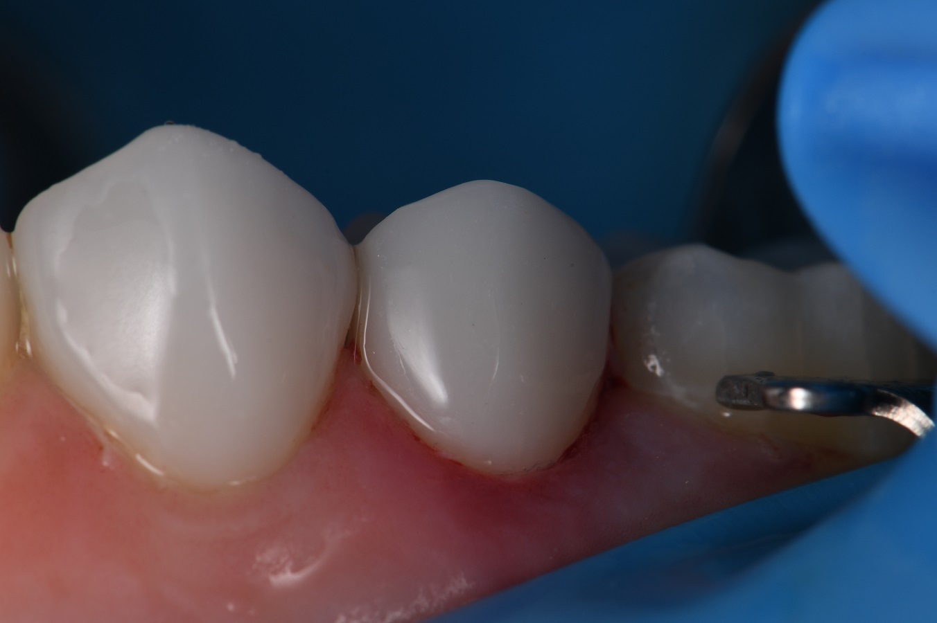 Supporting Buccal Corridors with Composite Veneers