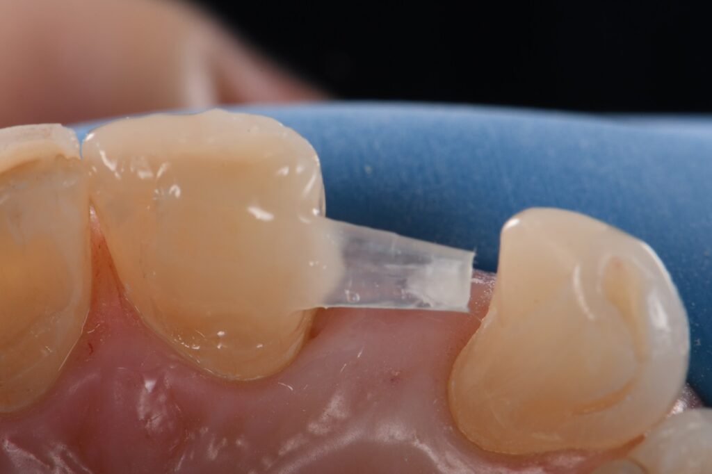 Freehand Resin Bonded Composite Bridge Voco GrandTEC