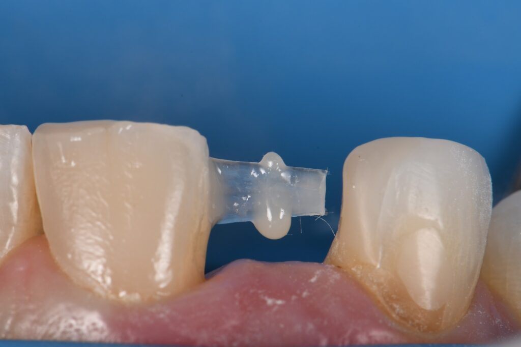 Freehand Resin Bonded Composite Bridge Voco GrandTEC