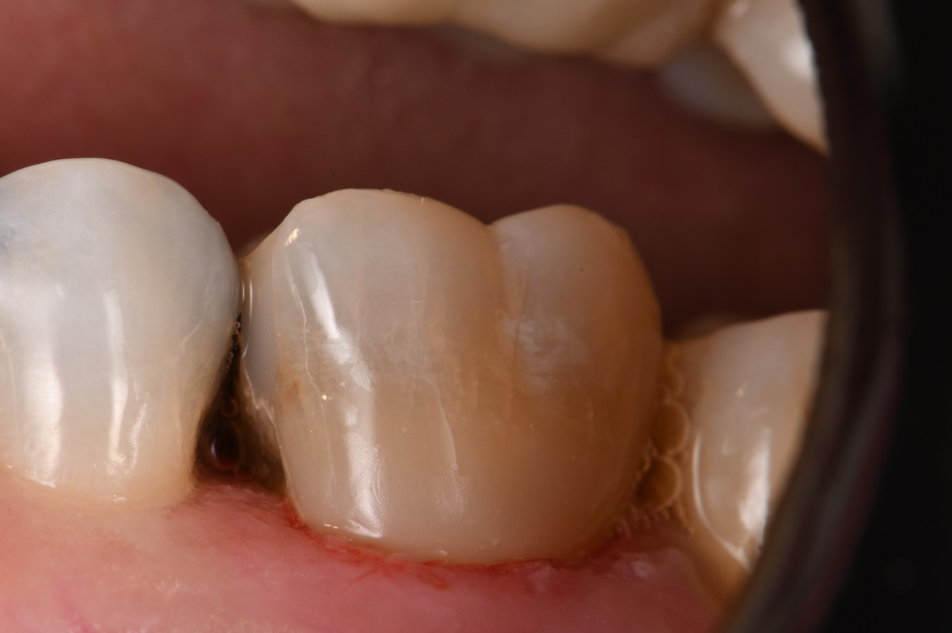 Toothbrush Damage to Teeth Restored Toothbrush Damage to Teeth Restored