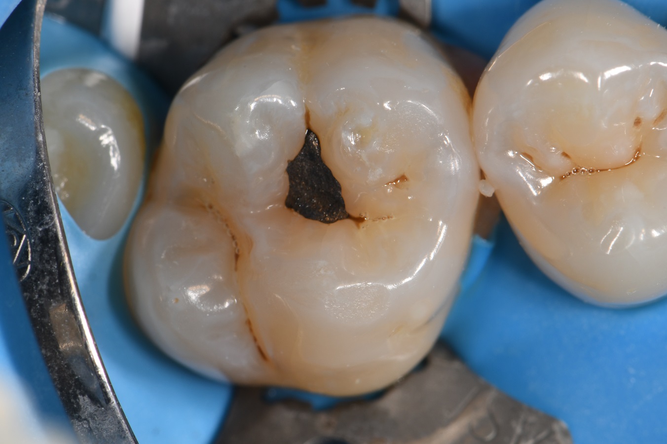 All Ceramic Composite no BPA All Ceramic Composite no BPA