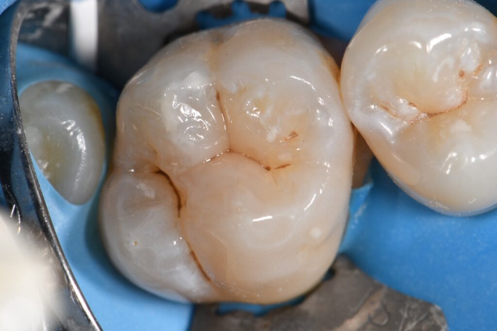 All Ceramic Composite no BPA All Ceramic Composite no BPA