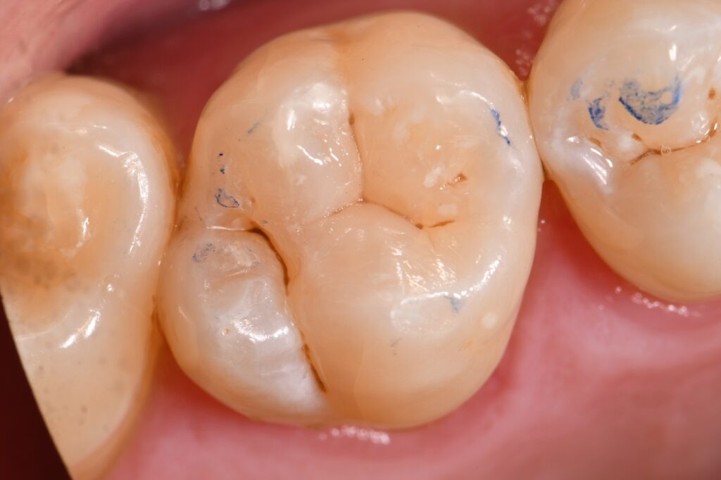 All Ceramic Composite no BPA All Ceramic Composite no BPA