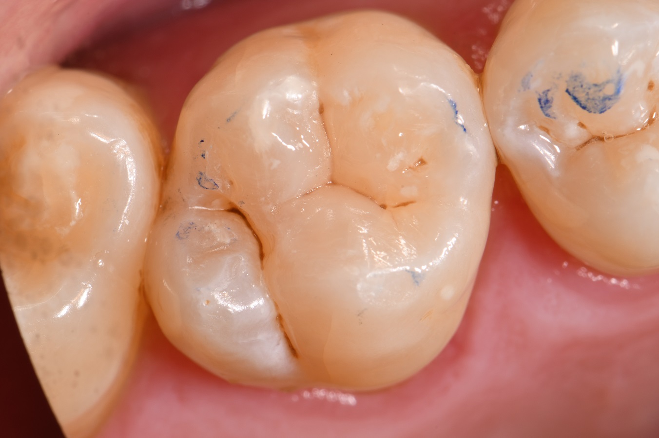 All Ceramic Composite no BPA All Ceramic Composite no BPA