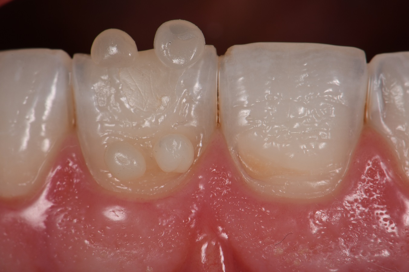 Resin Laminates Composite Veneers Auckland