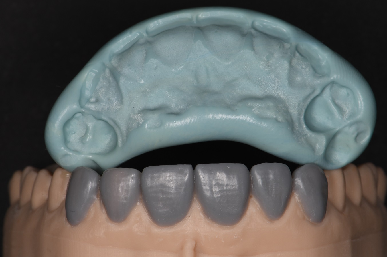 Resin Laminates Composite Veneers Auckland