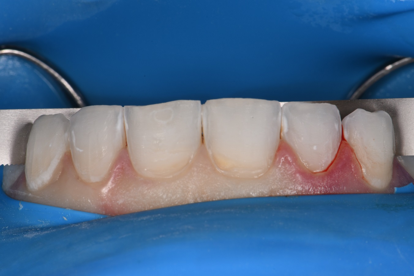 Resin Laminates Composite Veneers Auckland