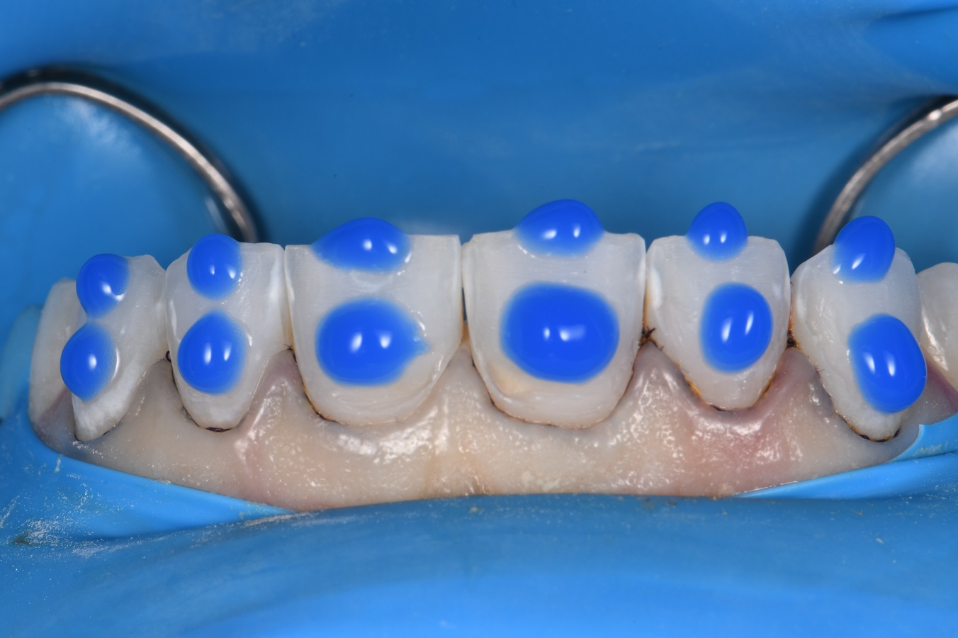 Resin Laminates Composite Veneers Auckland