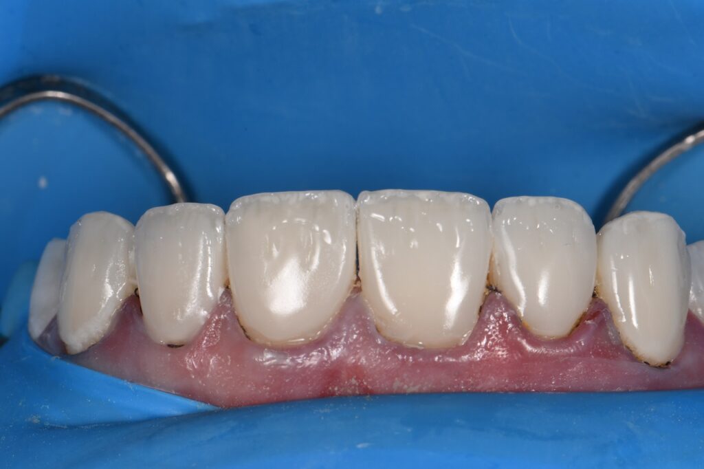 Resin Laminates Composite Veneers Auckland