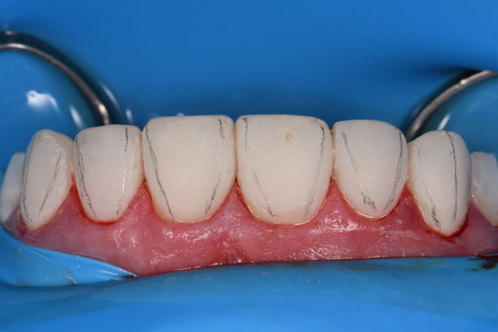 Resin Laminates Composite Veneers Auckland