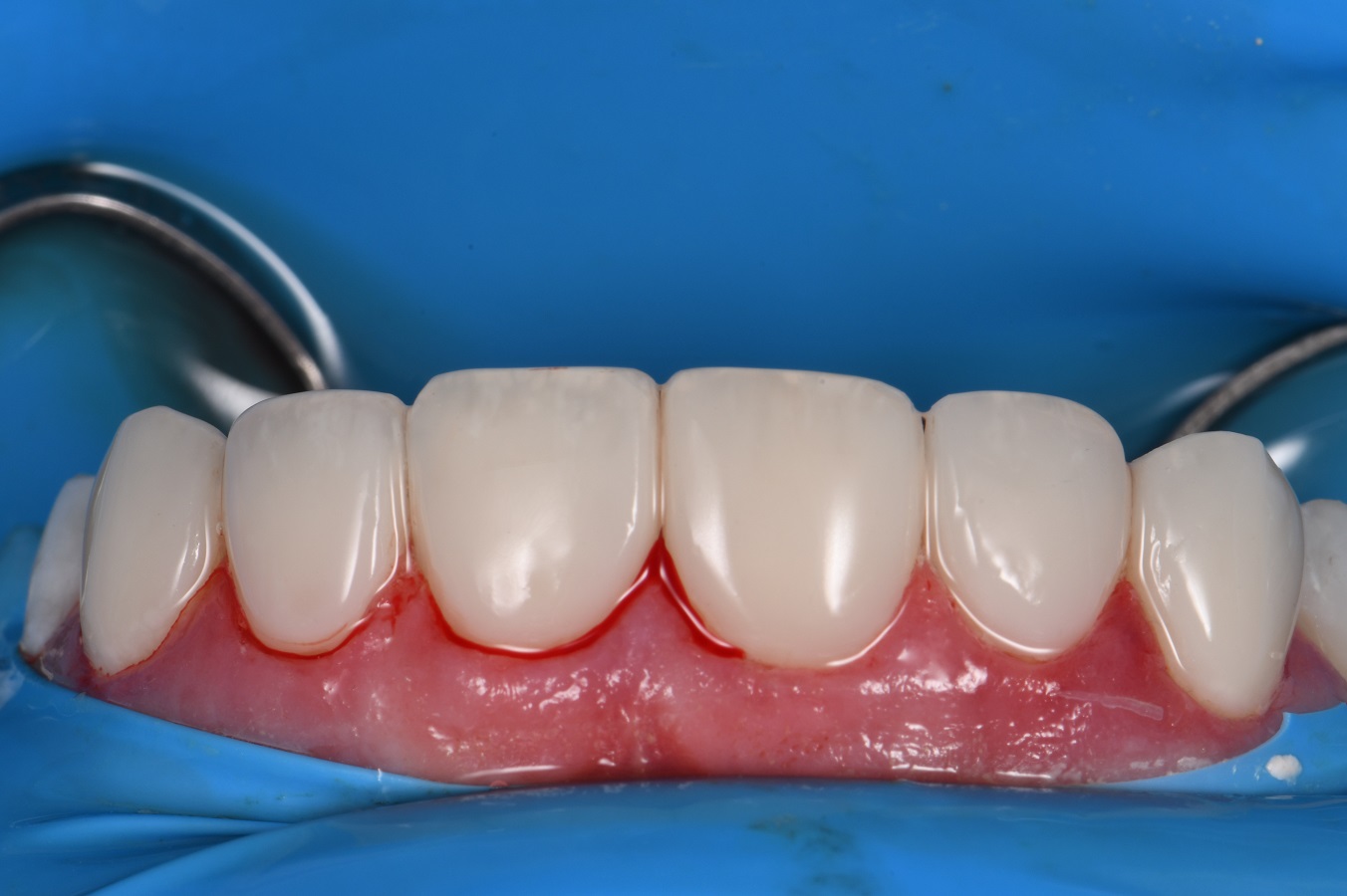 Resin Laminates Composite Veneers Auckland