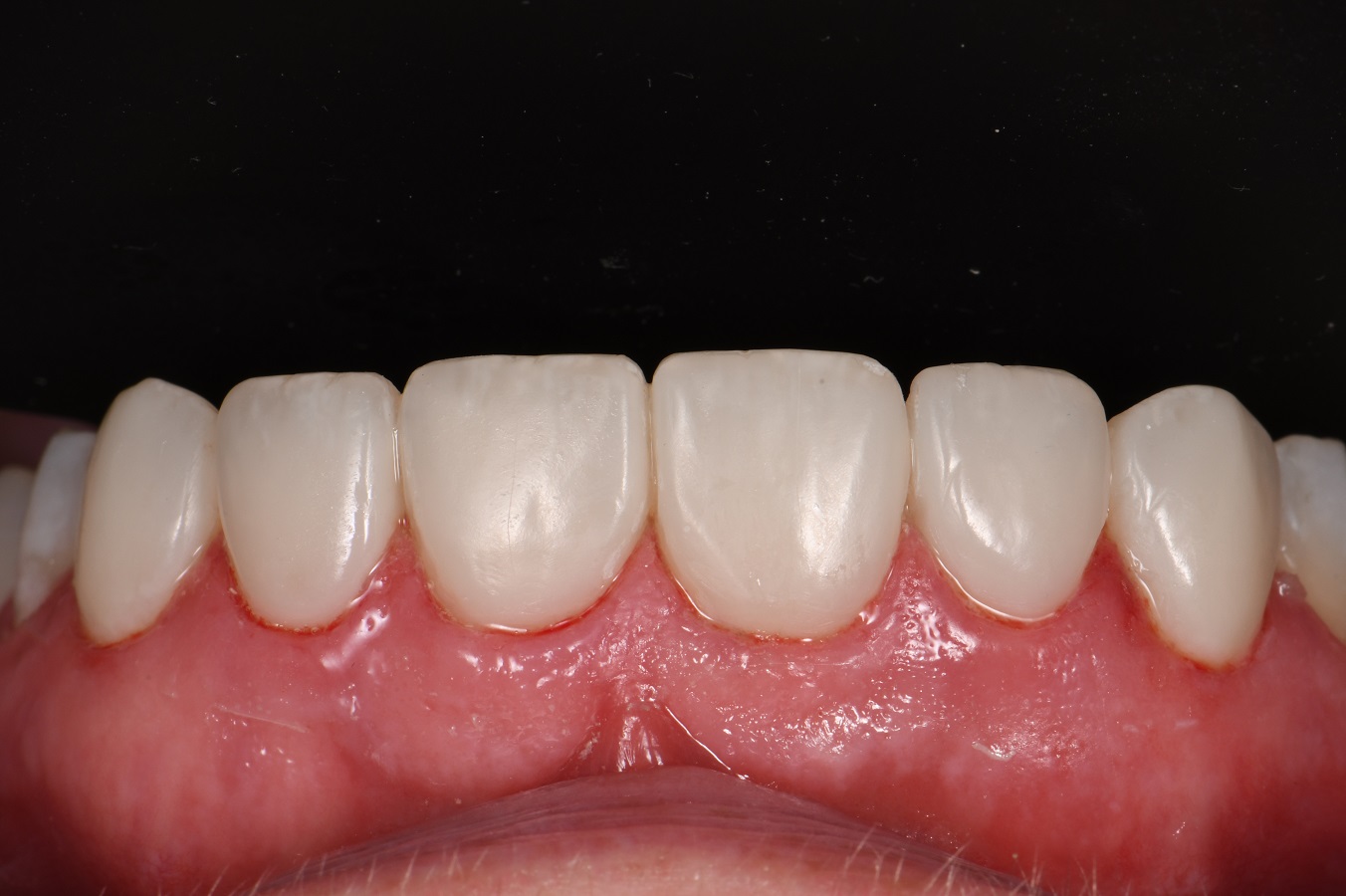 Resin Laminates Composite Veneers Auckland