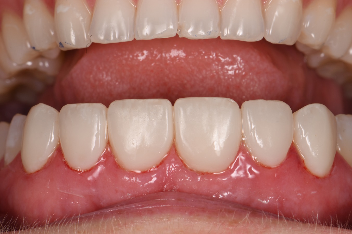 Resin Laminates Composite Veneers Auckland