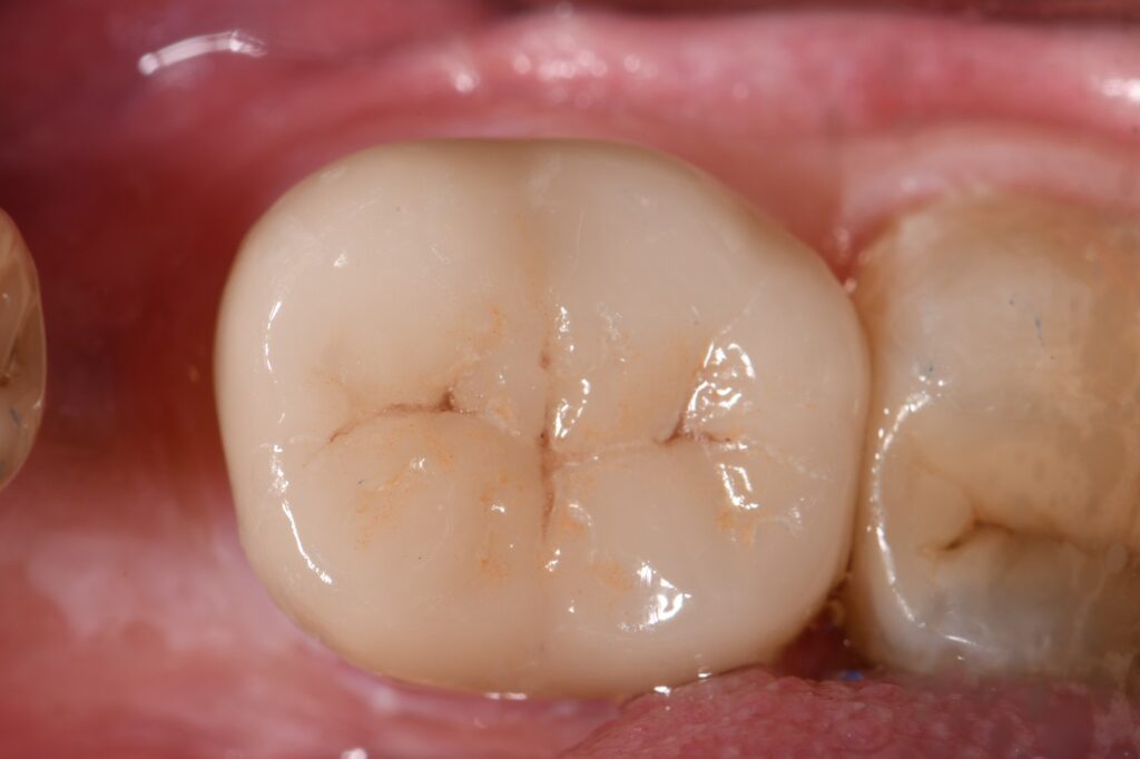 Porcelain Bonded Crowns Auckland