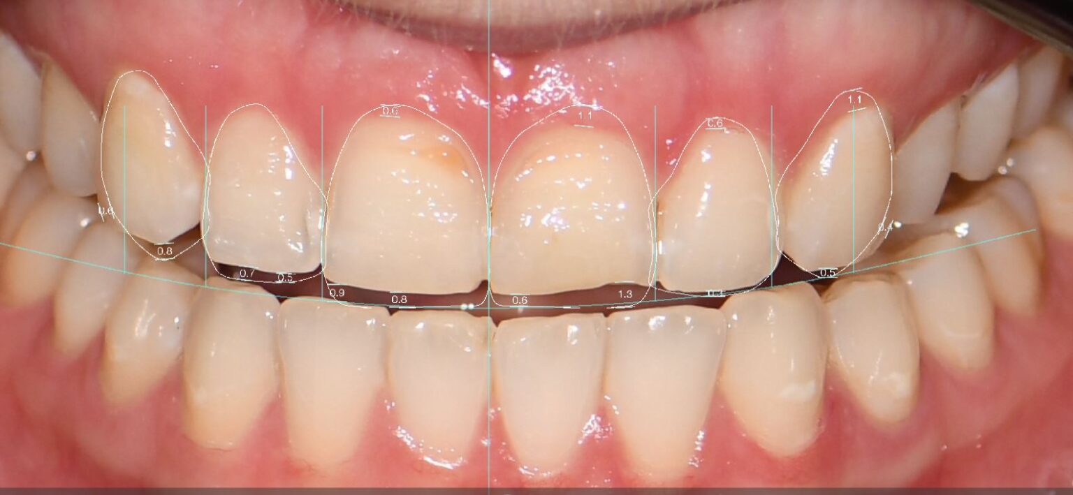 Resin Laminates Composite Veneers Auckland