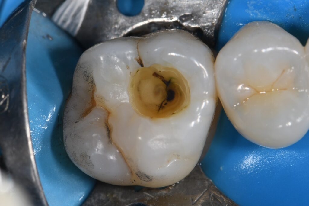 Safe Amalgam Removal and Biomimetic Restoration